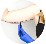 Braquioplastia