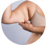 Lipodebrazo
