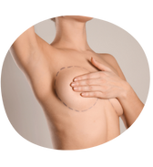 Mamoplastia