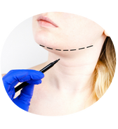 Mentoplastia