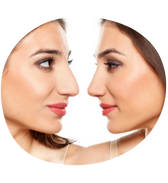 Rinoplastia