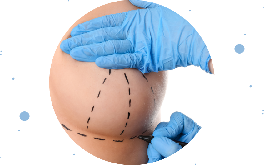 Mamoplastia de reducción